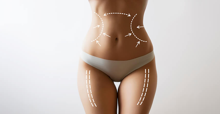 Liposuction, Liposuction