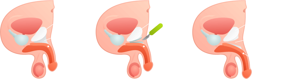 Surgry penis enlargement How Much