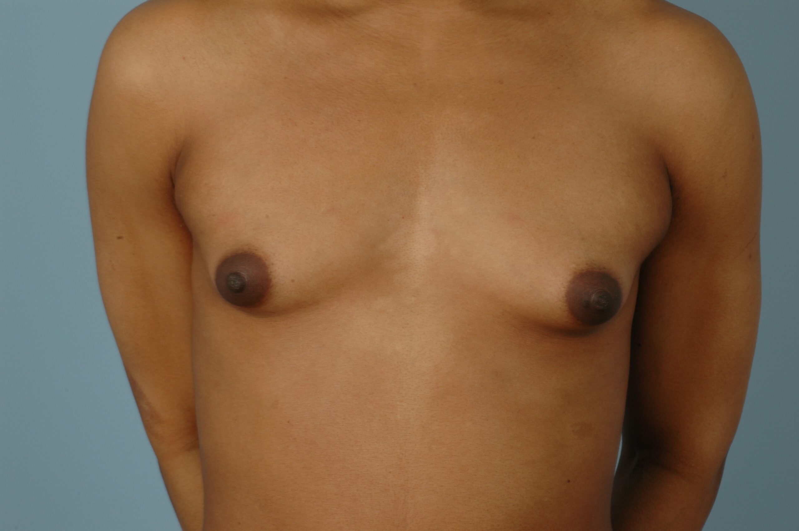 , Top Surgery