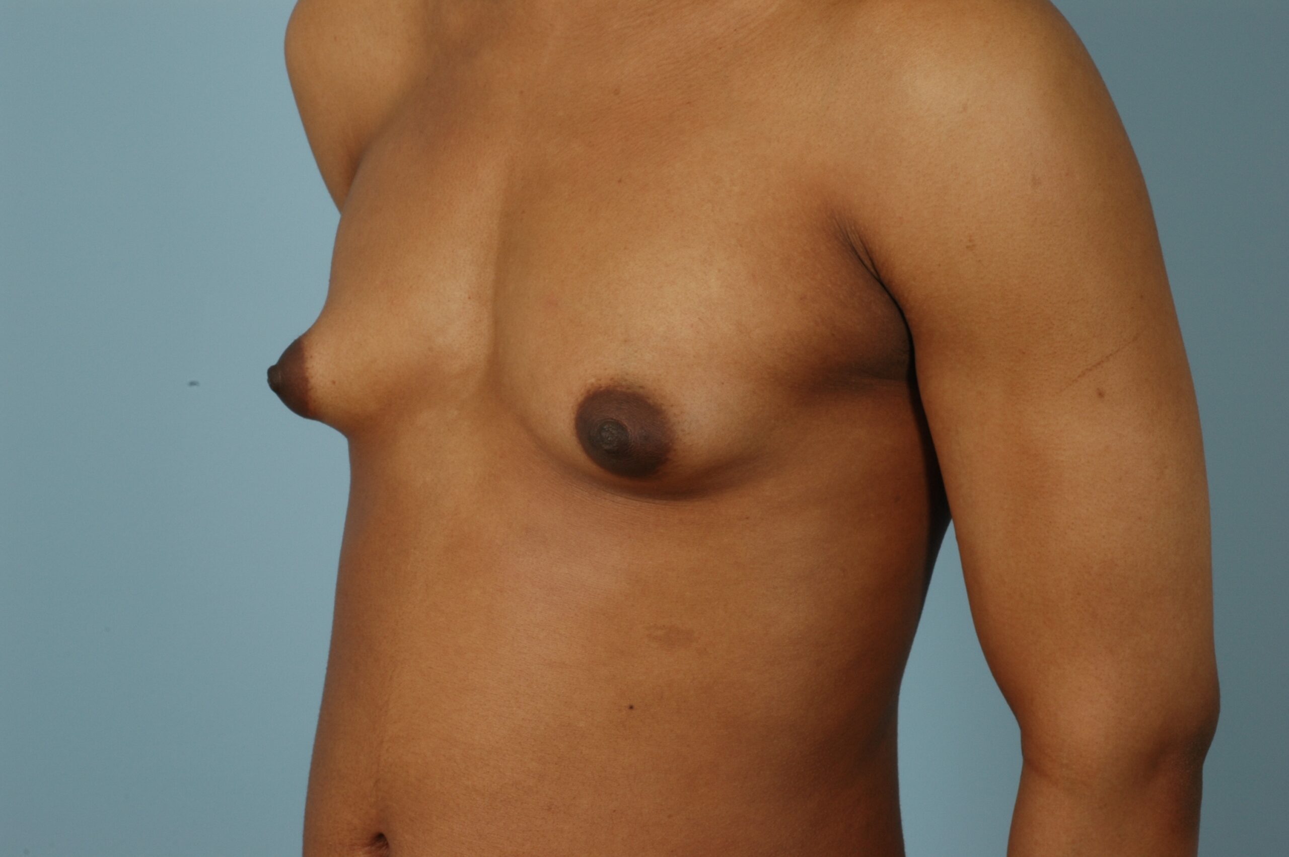 , Top Surgery