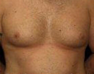 , Top Surgery