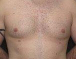 , Top Surgery