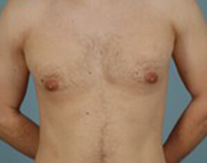 , Top Surgery