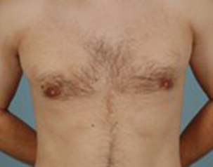 , Top Surgery