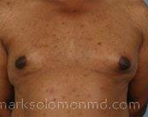 , Top Surgery
