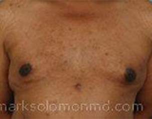 , Top Surgery