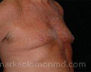 , Top Surgery