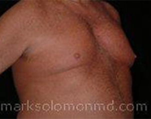 , Top Surgery