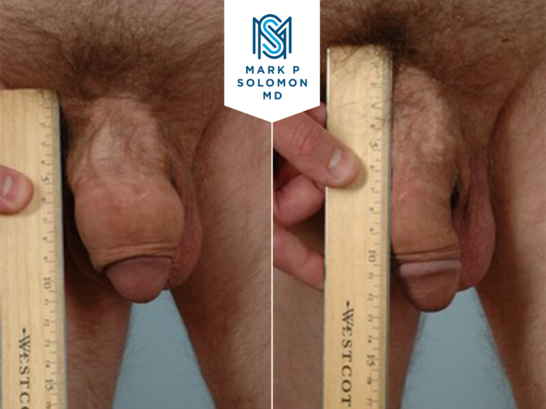 Penile lengthening &mdash; before and after surgery