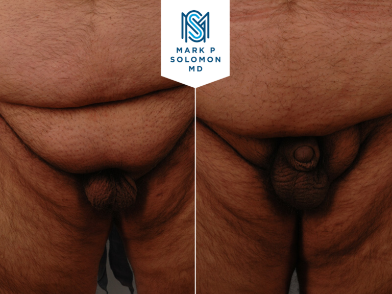 Hidden (buried) penis correction &mdash; before and after surgery