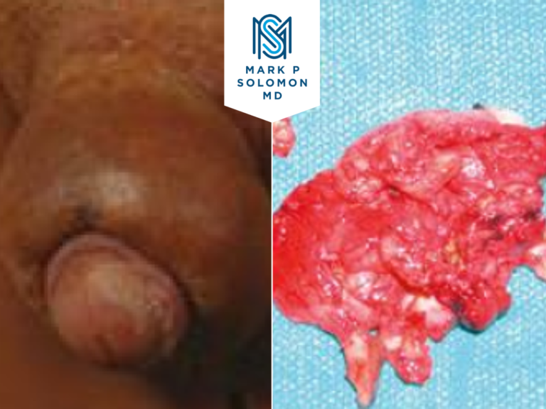 Liquid silicone removal &mdash; before and after surgery