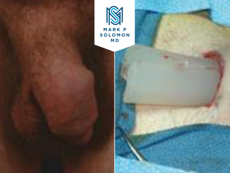 Penile implant removal &mdash; before and after surgery