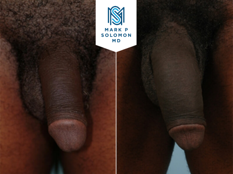 Penile girth enhancement &mdash; before and after surgery