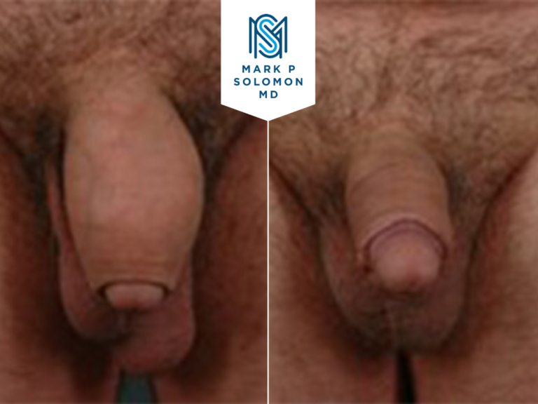 Penile fat graft removal &mdash; before and after surgery